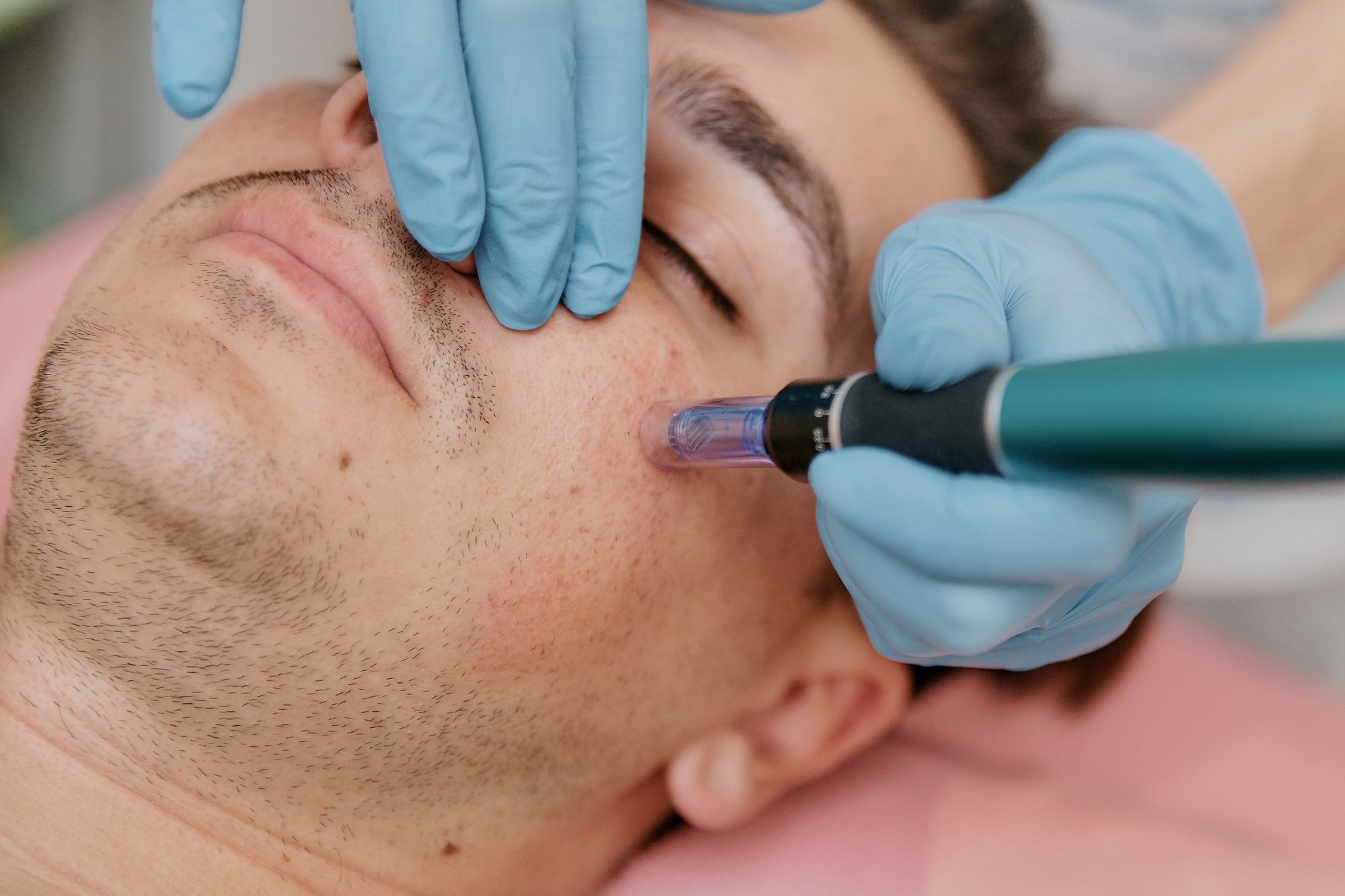 Skinpen Microneedling male patient at Stadia for Men in San Antonio